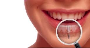 ¿Qué Son Los Implantes Dentales?